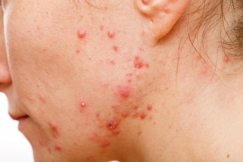 acne cyst back