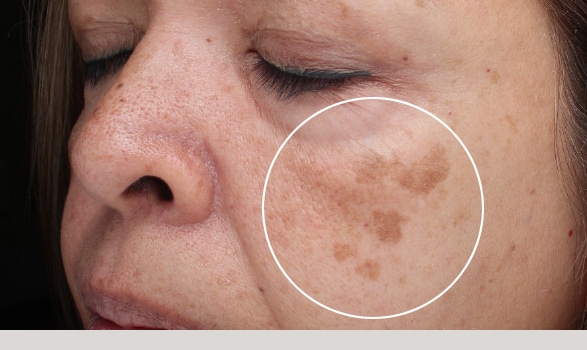 Dermatology Center of Loudoun, Blog, Brown Spots